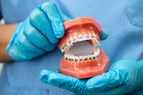 歯列矯正は高いので諦めていましたが、医療費控除が使えると聞きました。審美目的でも大丈夫ですか？
