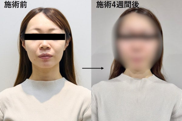 【4週間後の衝撃】アラサー編集部員が美容医療を受けた結果……「痩せた？」と言われるようになった話