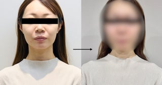 【4週間後の衝撃】アラサー編集部員が美容医療を受けた結果……「痩せた？」と言われるようになった話