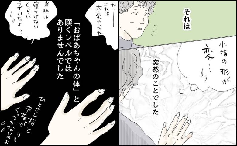「おばあちゃんの体みたい」小指の突然の変形に気付いた私。ママ友の両手を見た瞬間＜五十路日和＞