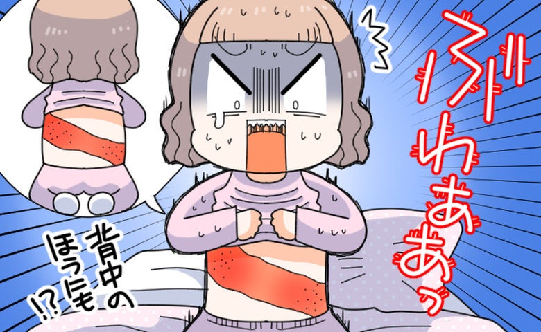 「あせもだと思っていた」発疹から5日後、眠れないほどの痛み。私に下った思わぬ診断【医師監修】