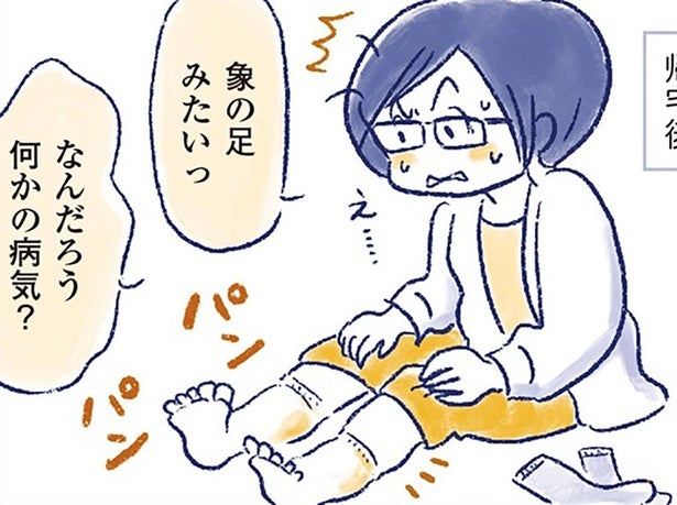 子宮筋腫を乗り越えたのに…。52歳、立っていられないほどの足のむくみに直面して／私の生理のしまい方（7）