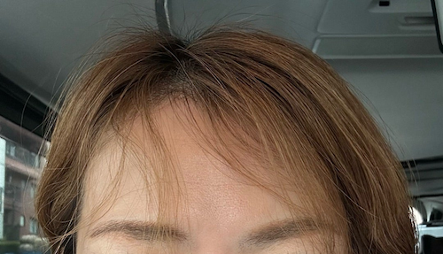  ココリコ遠藤の妻、前髪の異変で皮膚科受診「要は…」 