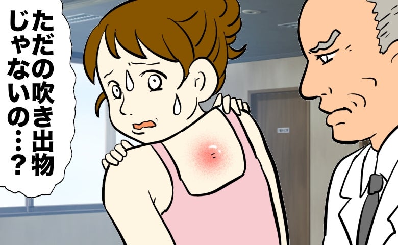 「ただの吹き出物かな」背中に大きなできもの。皮膚科で医師から告げられた言葉とは【医師解説あり】