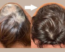 このままじゃ髪がヤバい！薄毛やパサパサ髪はよみがえるのか？人気沸騰の「育毛鍼灸師」に聞きました