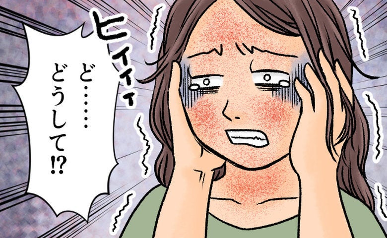 「顔が真っ赤」幼少期に落ち着いたはずなのに。40代で襲った肌の異変。腫れ上がりヒリヒリした理由は