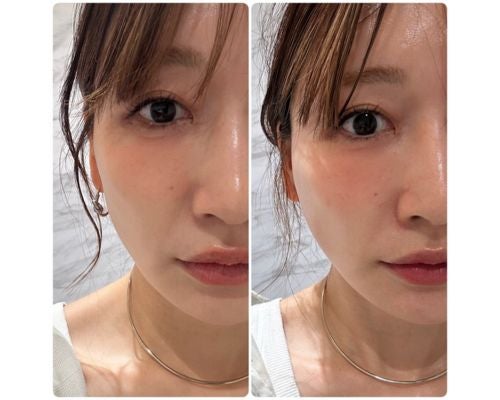  あいのり・桃、糸リフト施術後の変化に驚き＆ビフォアフ写真も 