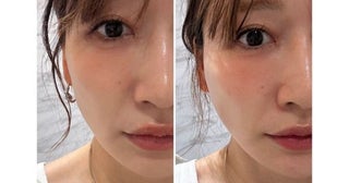  あいのり・桃、糸リフト施術後の変化に驚き＆ビフォアフ写真も 