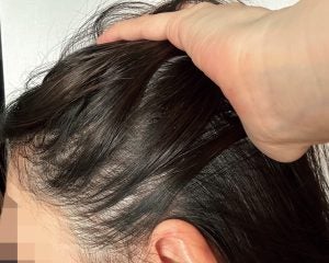 話題の“やせ薬”マンジャロで髪が抜け、救急搬送も。美容目的で手を出した女性たちが払った「大きな代償」
